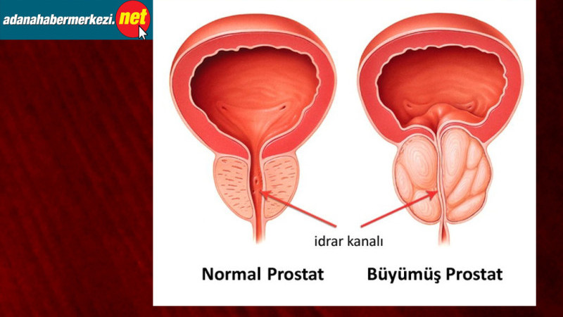 Prostat Hastalıkları İle İlgili 10 Yanlış İnanış